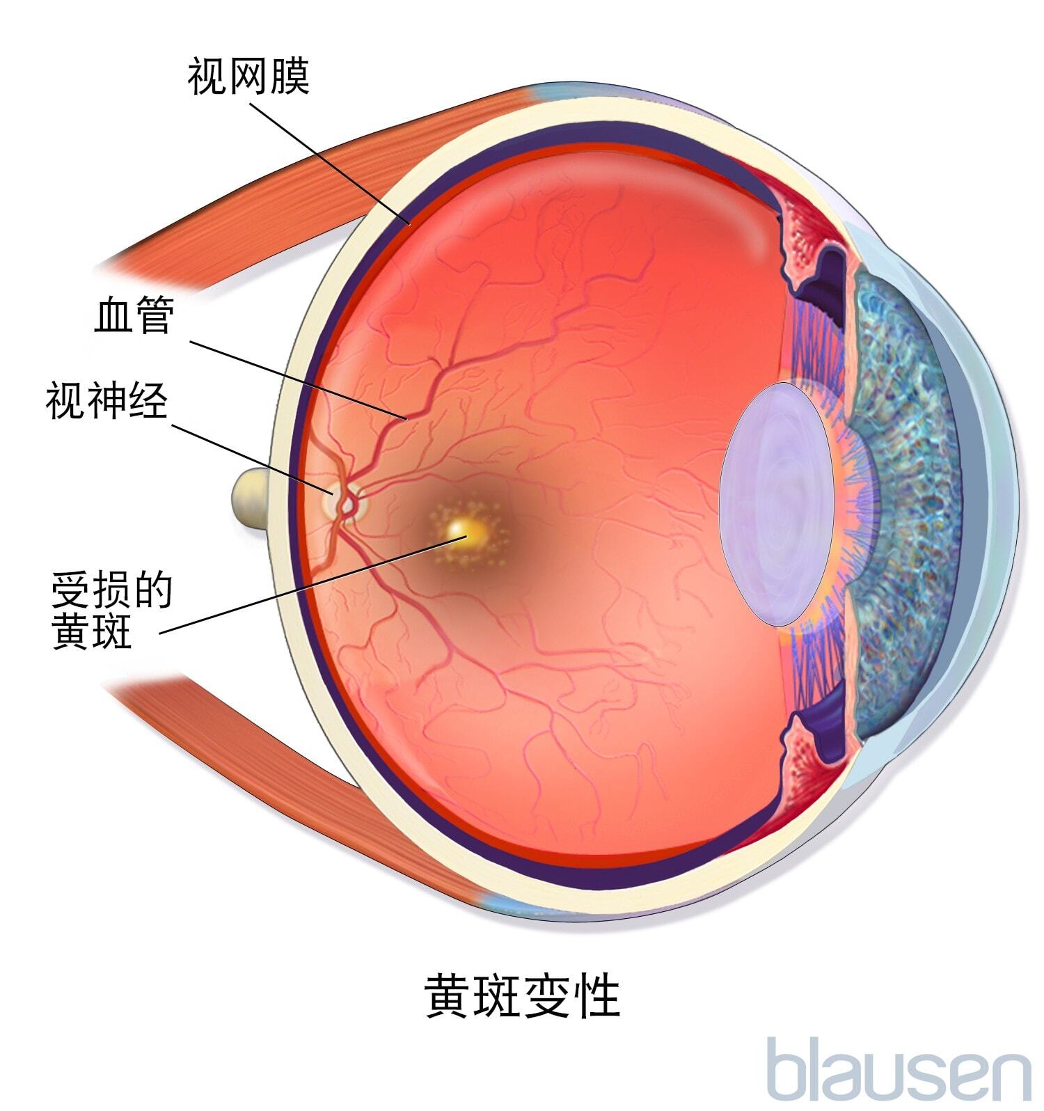 黃斑部病變留不住僅剩視力